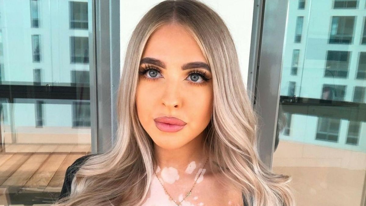 Anna choruje na bielactwo od 8 roku życia