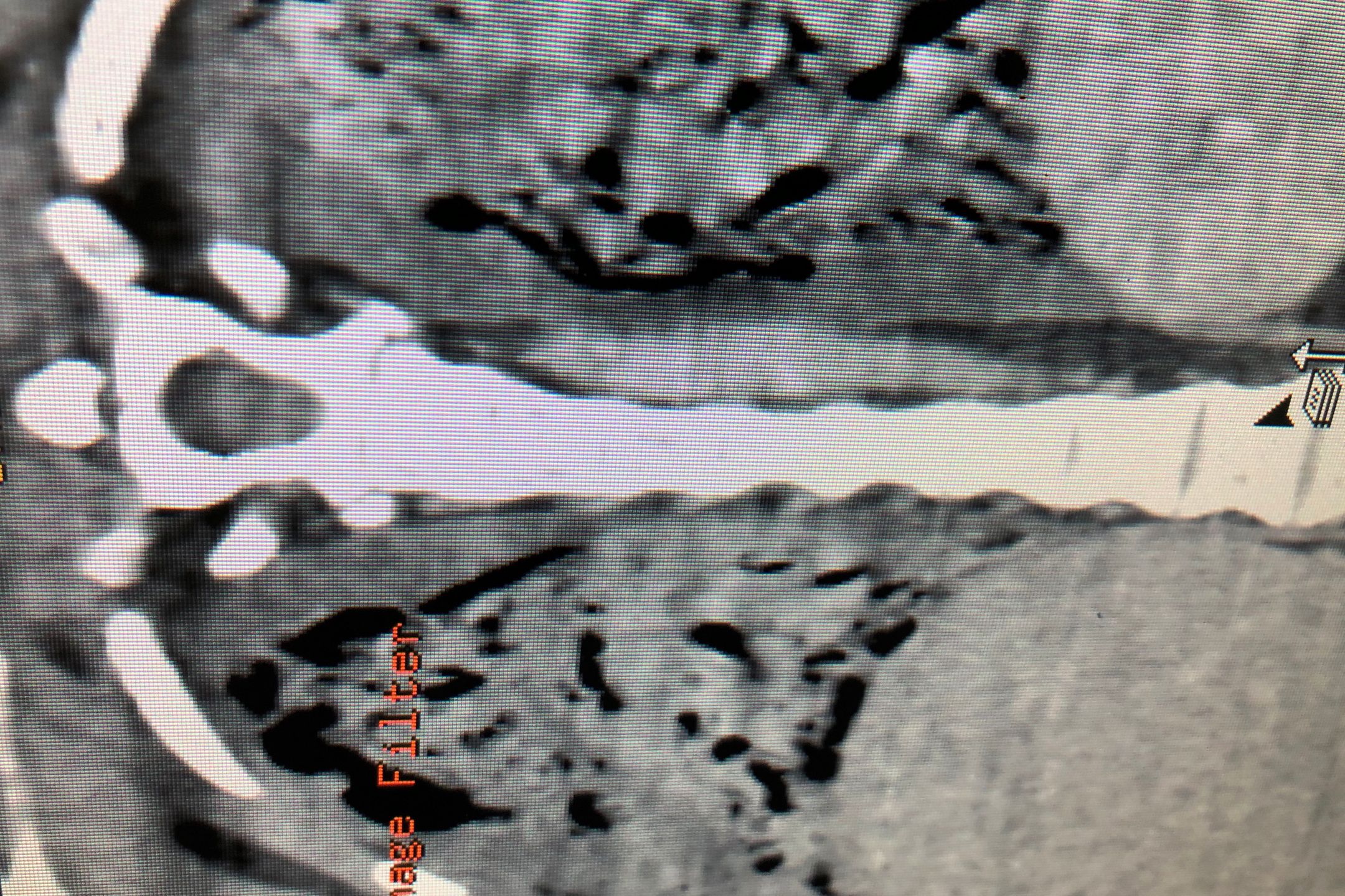 Płuca osoby zakażonej koronawirusem