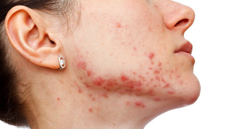 Nużeniec wywołuje chorobę, której objawami są dolegliwości skórne