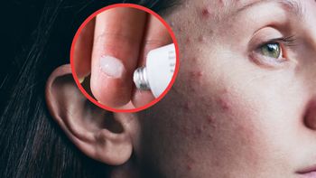 Pomaga na wszystkie problemy skórne. Mówią o tej maści "złoto w tubce"