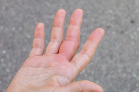 Czerwone dłonie mogą świadczyć o problemach z wątrobą