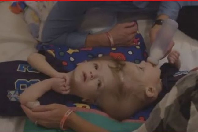 Operacja rozdzielenia bliźniaków trwała aż 20 godzin