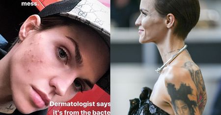 Wychudzona Ruby Rose tłumaczy się z wysypki: "To od wywiadów udzielanych przez telefon i brudnej poszewki"
