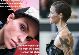 Wychudzona Ruby Rose tłumaczy się z wysypki: "To od wywiadów udzielanych przez telefon i brudnej poszewki"