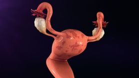 Endometrioza - tajemnicza choroba (WIDEO)