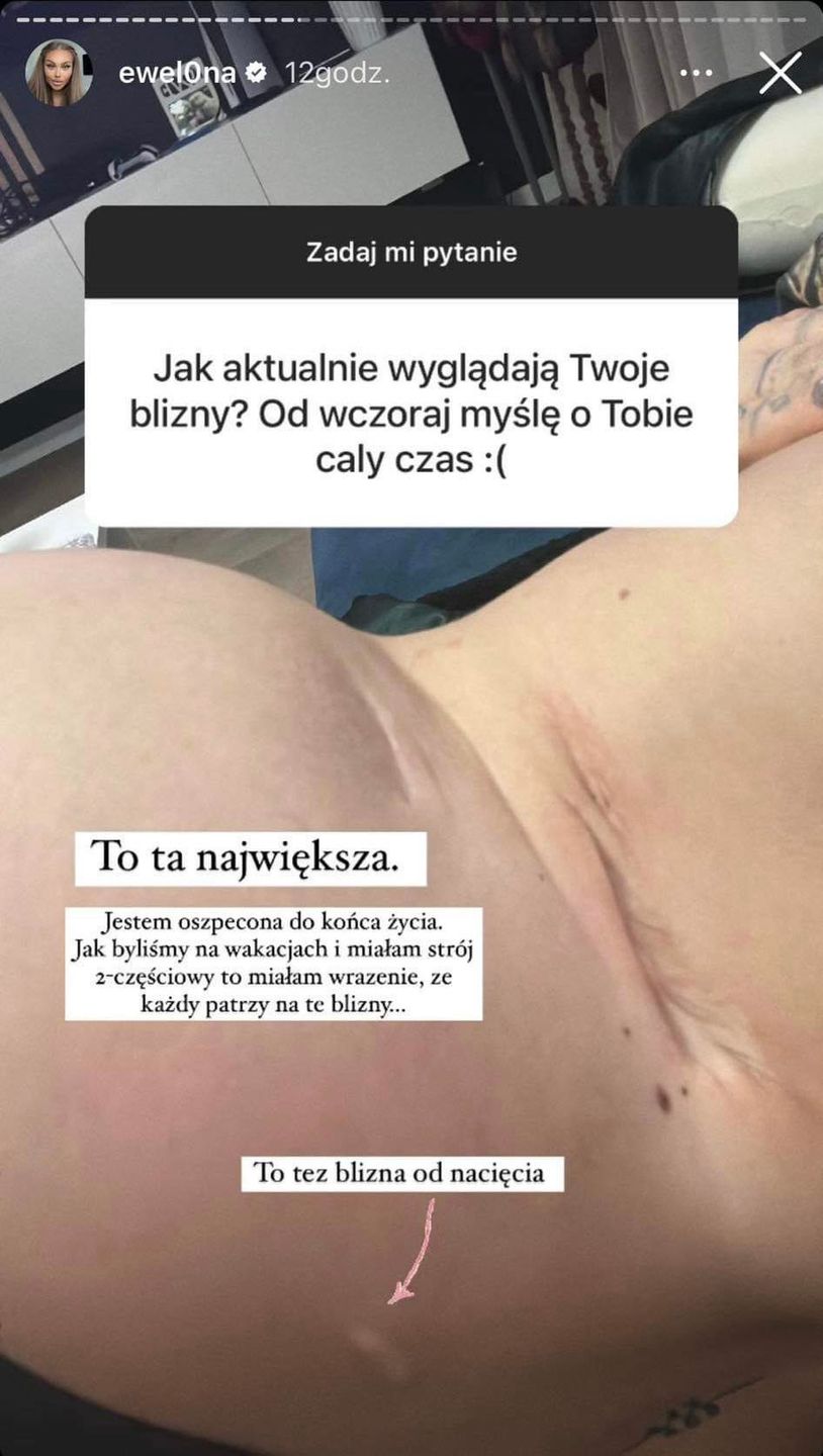 Ewel0na walczyła o życie. Pokazała blizny