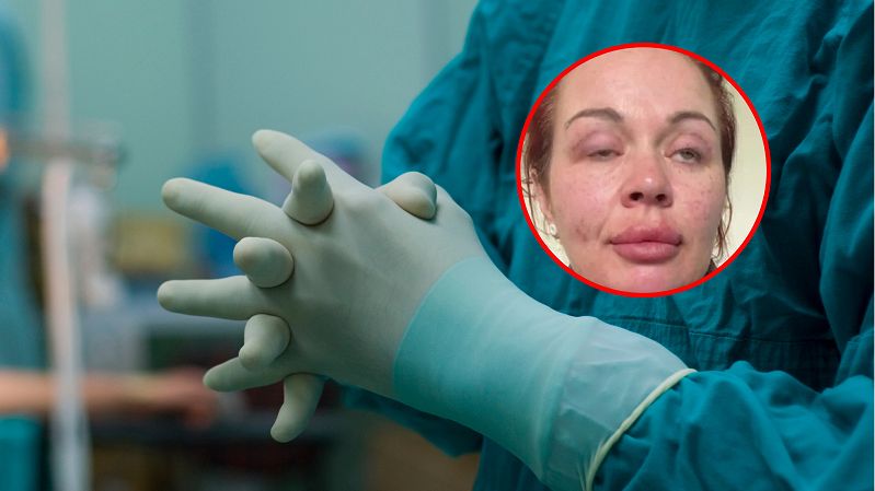 Nie powiodła się plastyka oka w Turcji. Teraz kobieta ma kłopoty z mruganiem