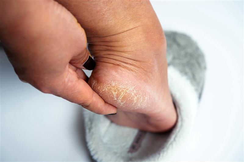 Wsmaruj w suche pięty. Efekt zobaczysz już po jednej nocy