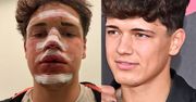 Polski influencer miał GROŹNY wypadek. "Skończyło się szwami i uszkodzonymi zębami"