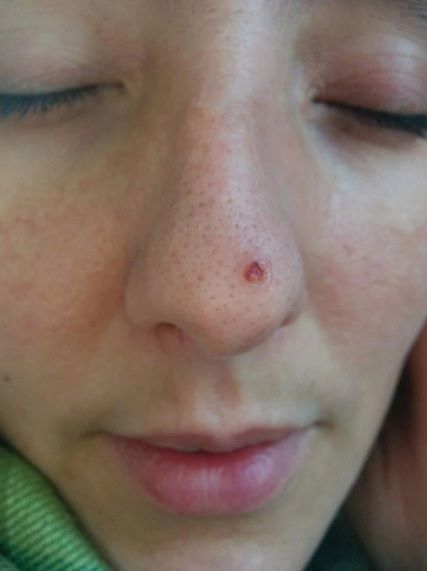 Kobieta sądziła, że ma na nosie pryszcza