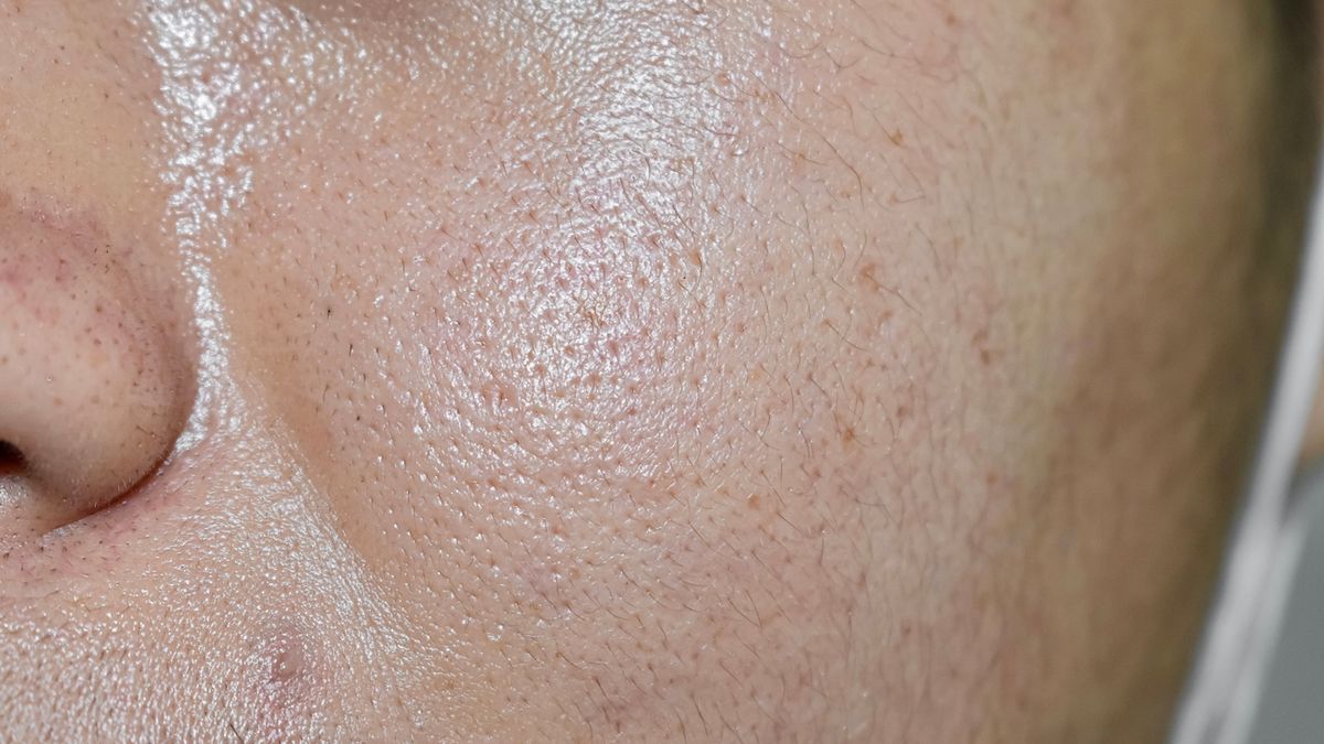 Sebum w nadmiarze to inaczej łojotok