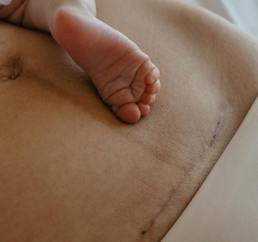 Halejcio pokazała bliznę