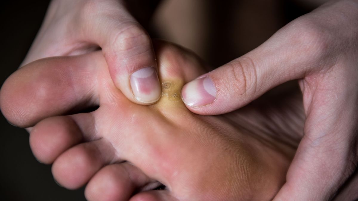 Nagniotki łatwo pomylić z kurzajkami