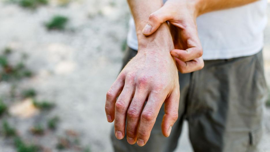Sucha skóra dłoni nie jest objawem Covid-19.