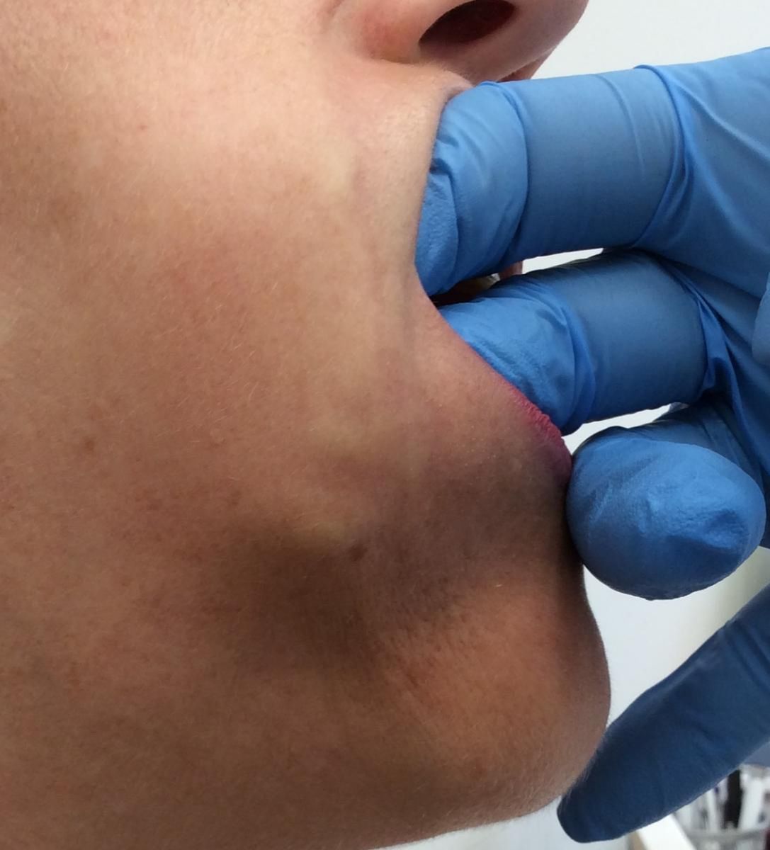 Kobieta ma guzy po wstrzyknięciu kwasu hialuronowego