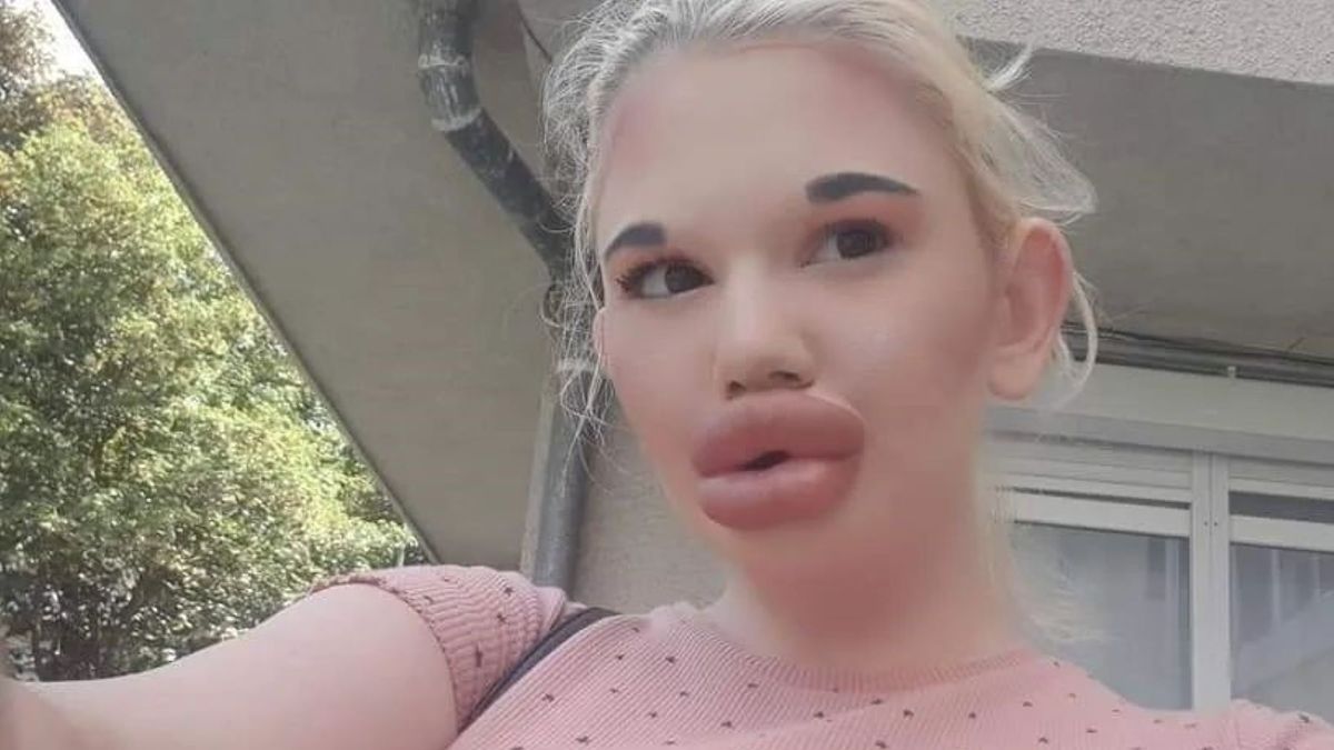 26-latka wciąż poddaje się operacjom plastycznym