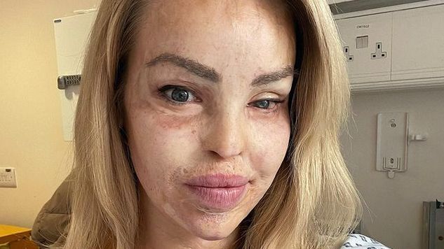 Tak wygląda teraz Katie Piper, która 13 lat temu została oblana kwasem 