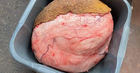 Wrocław. Guz ważył 6 kilogramów. Rita już po operacji