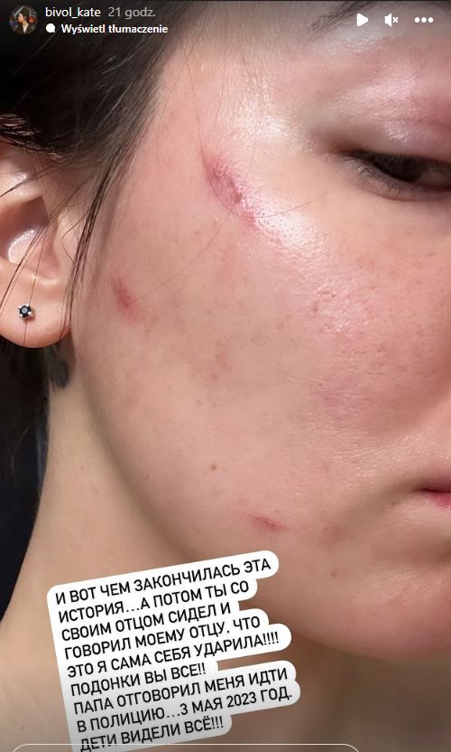 In the photo: Dmitry Bivol's wife shows how the boxer abused her.