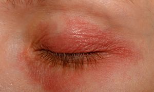 Utrata wzroku po terapii na otyłość? Ekspertka uspokaja