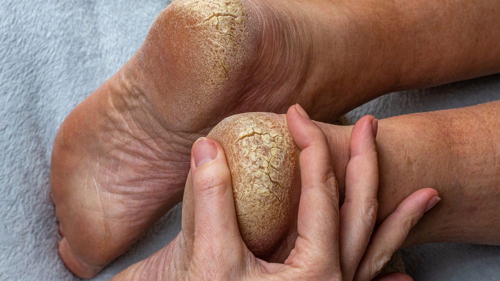 Pękające i suche pięty? To może być niedobór ważnych witamin