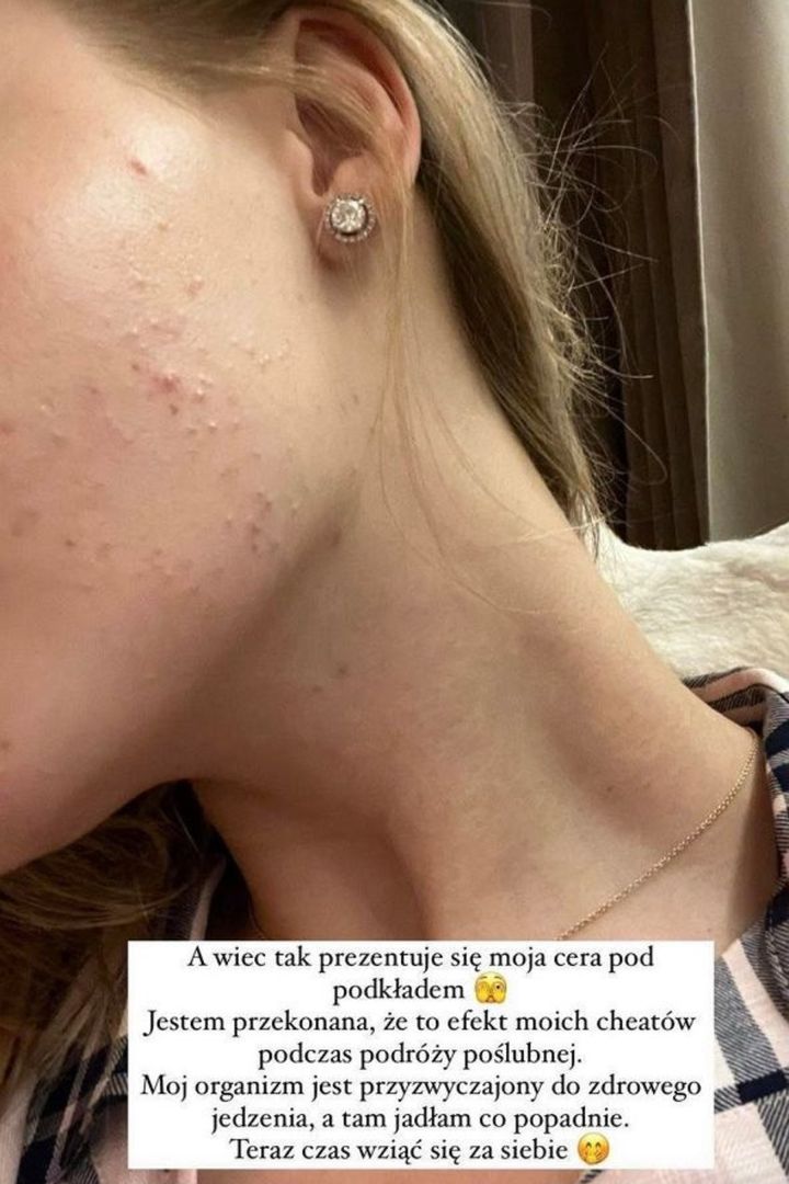 Modelka przyznała, co jest powodem problemów z cerą