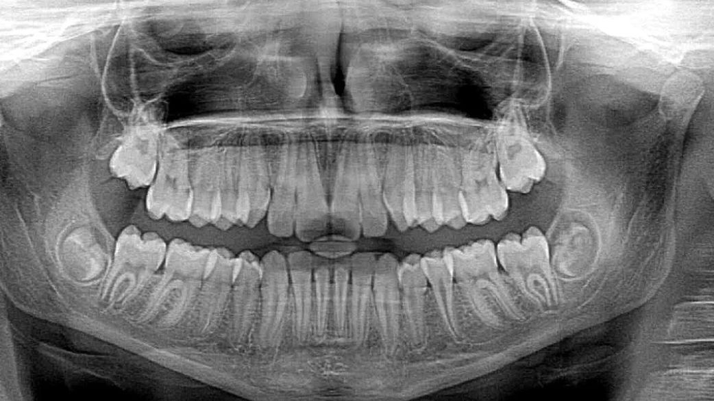 Rentgen to jednostka dawki promieniowania jonizującego, aparat emitujący promieniowanie rentgenowskie, a także wynik badania radiologicznego, czyli zdjęcie RTG.