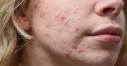 Pewnie zmieniasz ją za rzadko. Wtedy na twarzy pojawiają się wypryski