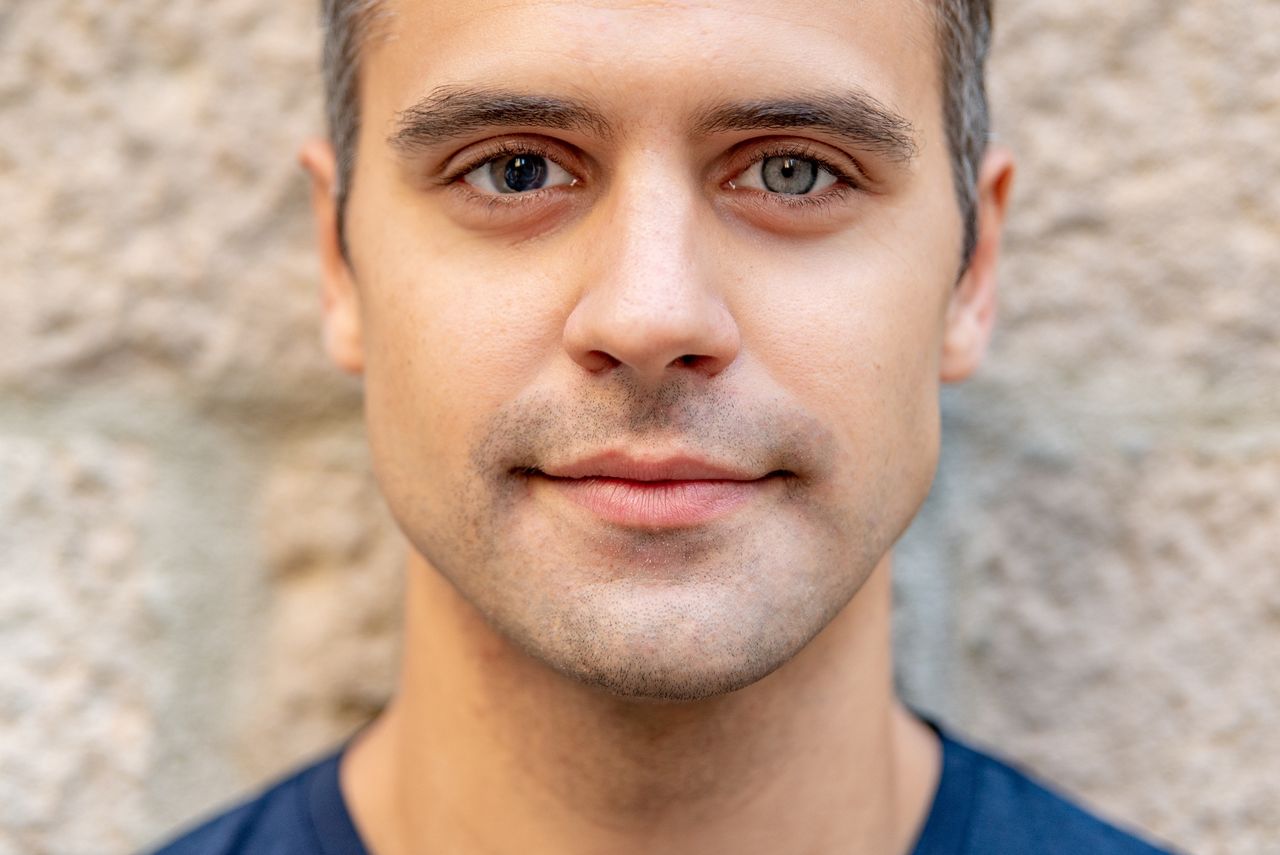 Heterochromia affects 1 percent of the population.