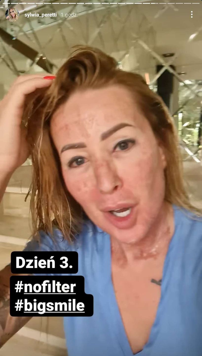 Sylwia Peretti pokazuje kolejny etap po zabiegu laserowym. Jest lepiej? 