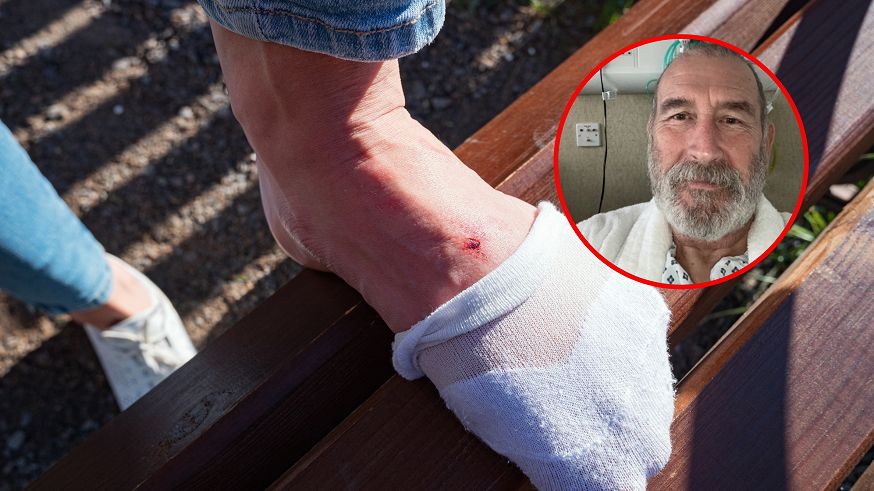 Niepozorna rana na stopie była objawem czerniaka. Rak rozprzestrzenił się na płuca i węzły chłonne