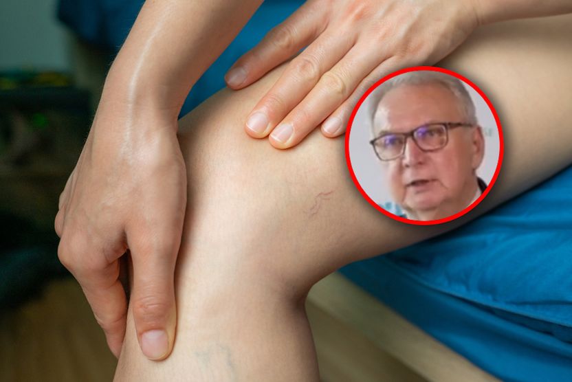 Prowadzi do zakrzepicy. "Dla żył to jest absolutny dramat"