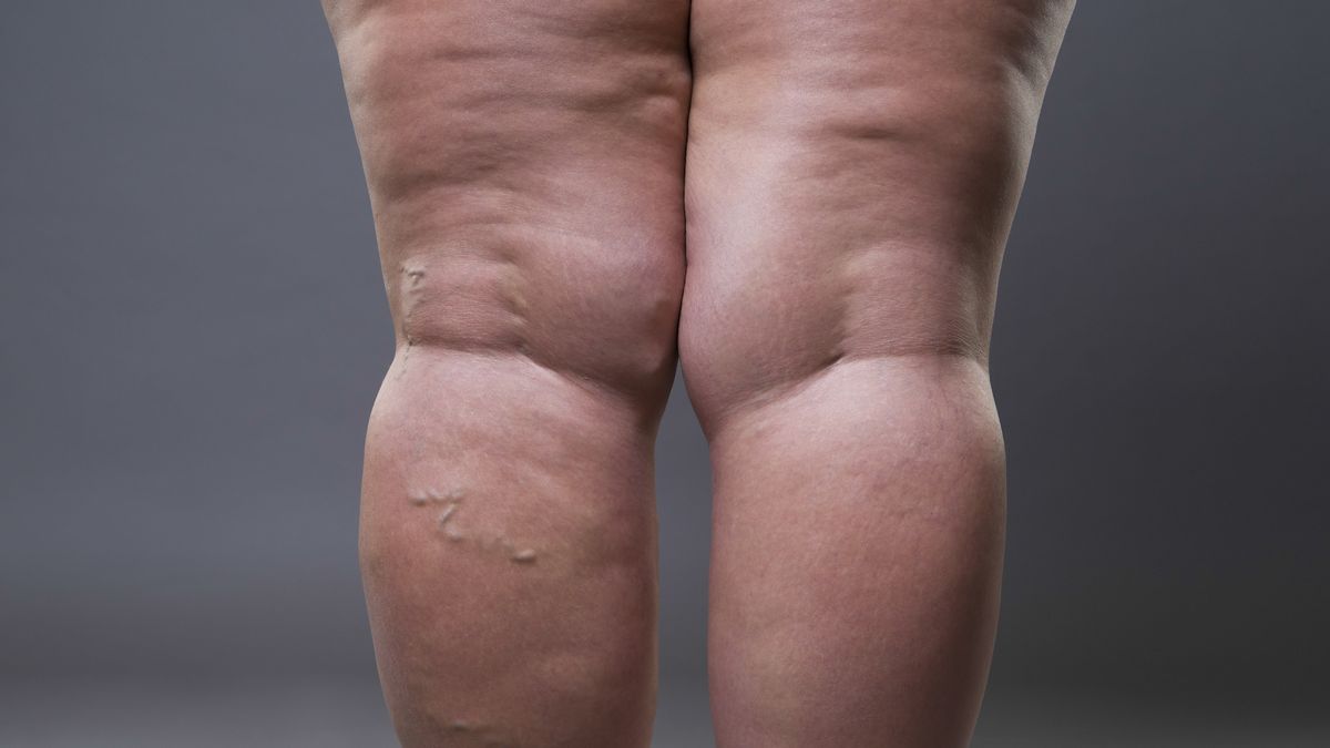 Grube nogi mogą być objawem choroby 