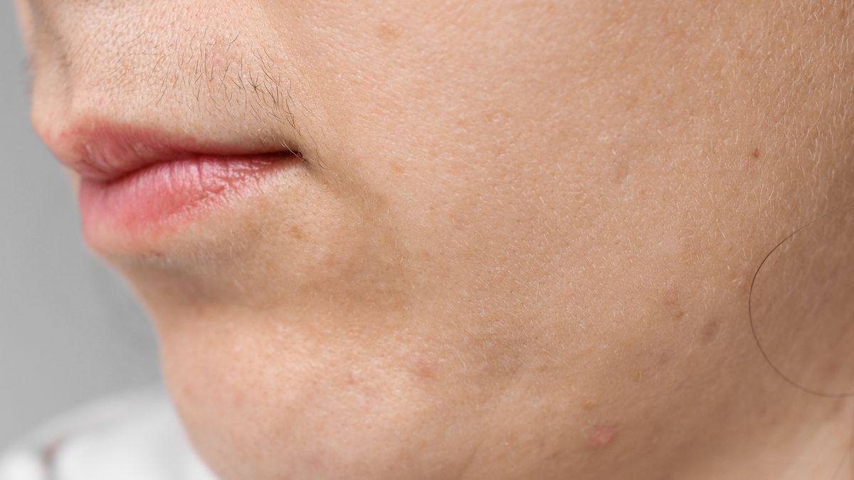 Jak pozbyć się wąsika? 