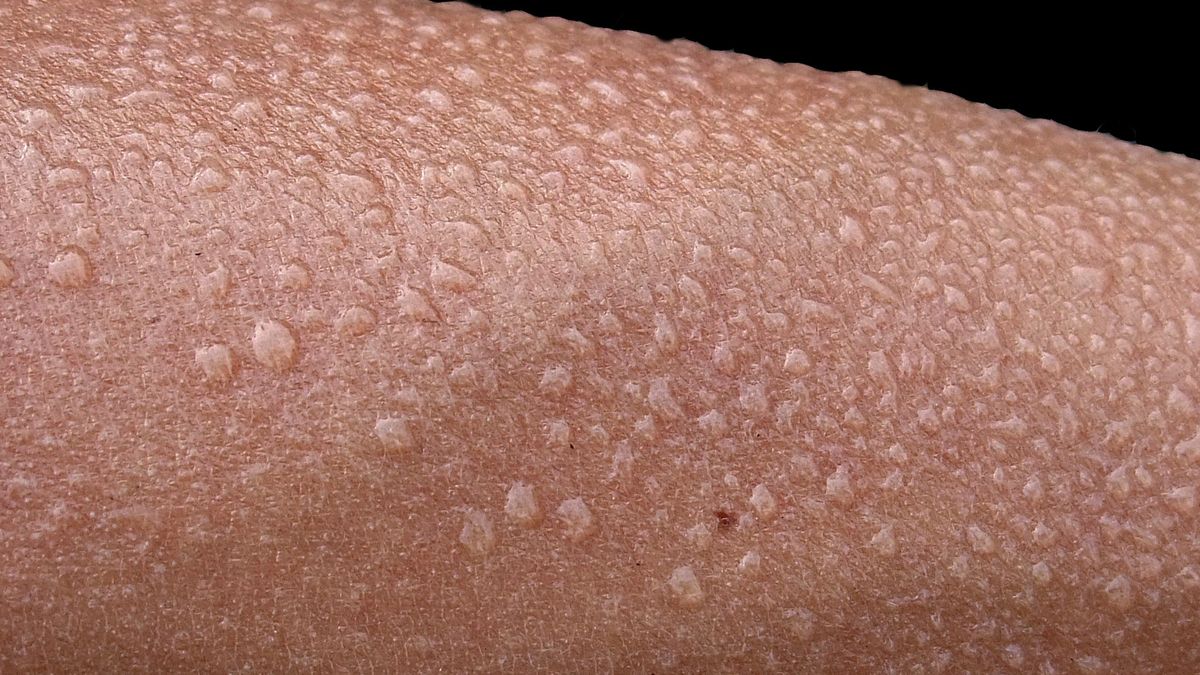 Nadmierna potliwość  - jak sobie z nią radzić 1