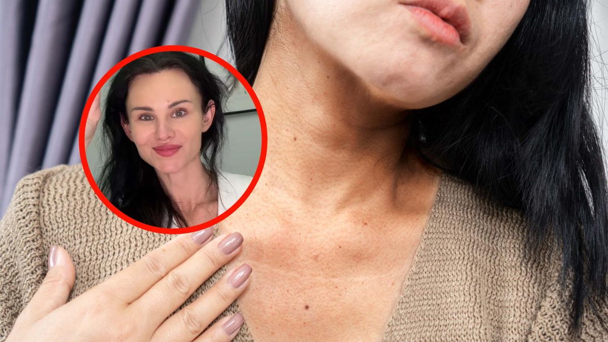 Ciemne zmiany na skórze to nie zaniedbanie higieny. Mogą świadczyć o poważnych chorobach