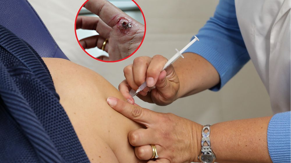 W ślad za nowymi przypadkami małpiej ospy, sieć obiega fala fake newsów