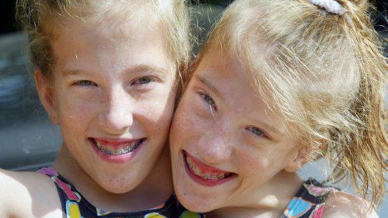 Abby i Brittany Hensel