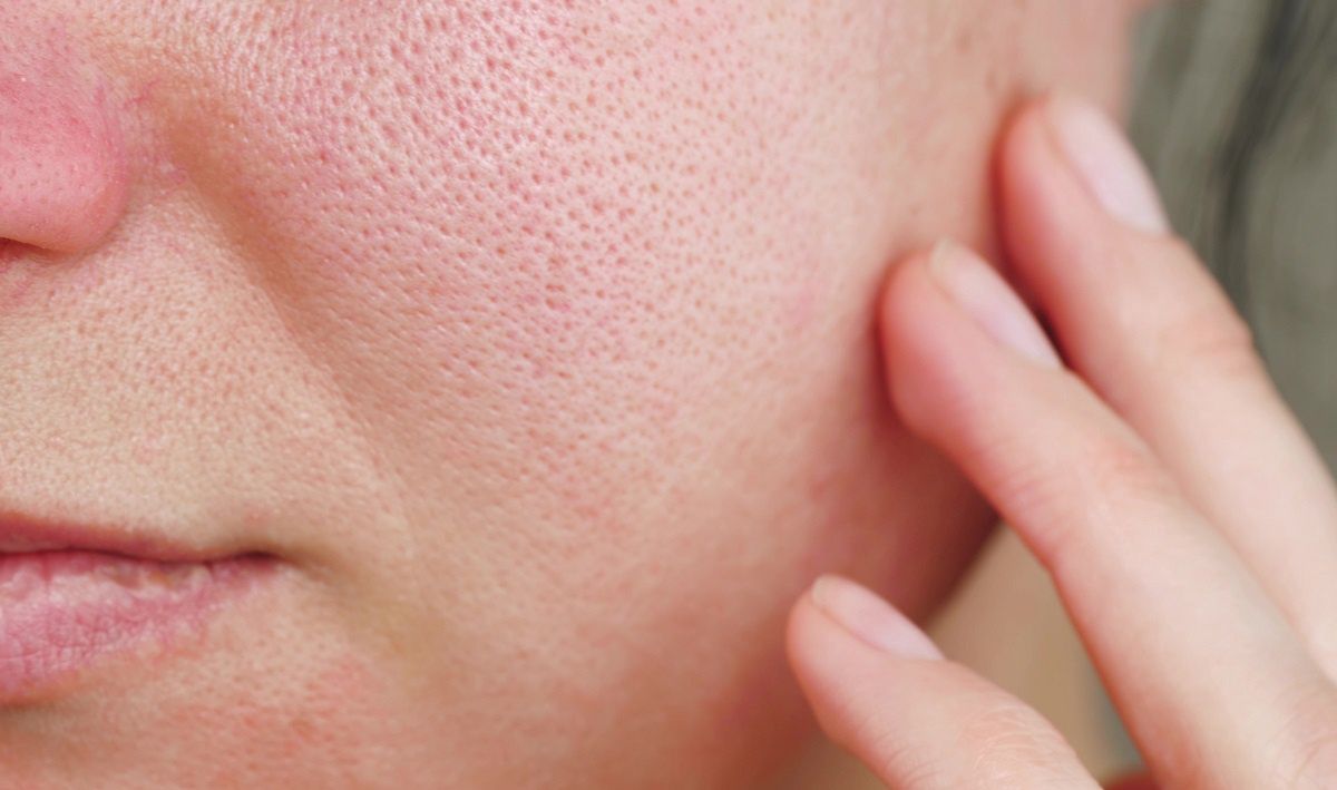 What helps with enlarged pores?