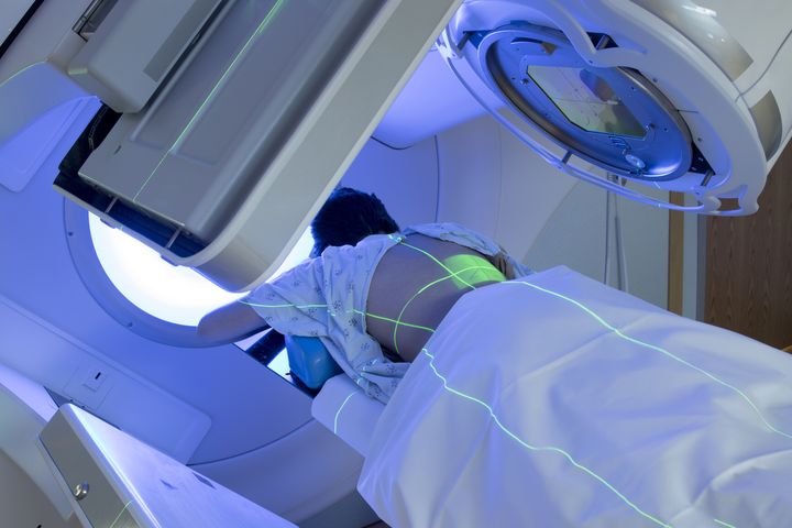 Aplazja szpiku może być spowodowana radioterapią.