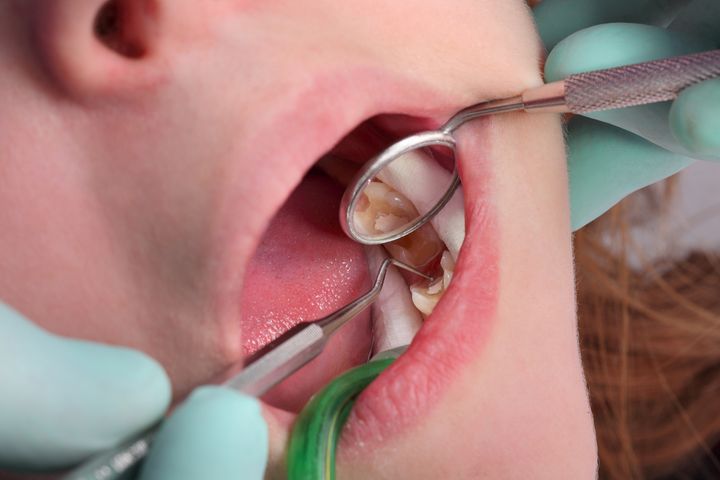Dziura w zębie wymaga natychmiastowego leczenia, które jest mniej bolesne niż leczenie większych ubytków.