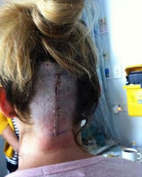 Lekarze myśleli, że to zwykła infekcja ucha. W jej głowie rozwijał się niebezpieczny guz mózgu