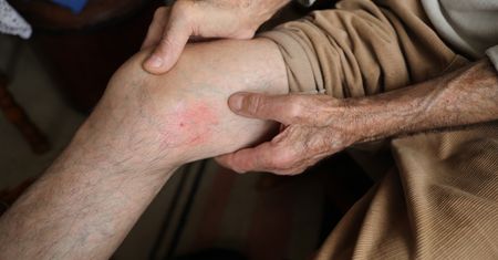 Pojawia się na skórze. Alarmuje, że sercu brakuje tlenu