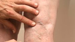 Skazy zakrzepowo-zatorowe - charakterystyka, przyczyny, leczenie