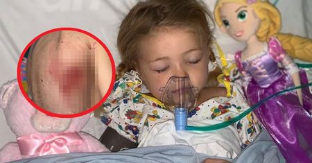 Matka myślała, że to ospa. Mięsożerna bakteria zaatakowała 4-latkę