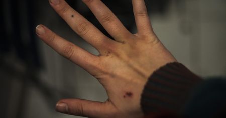 Jedyny objaw pojawił się na dłoni. Okazało się, że 30-latka ma raka