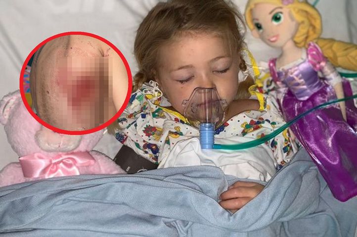 Miała klasyczne objawy ospy wietrznej. 4-latka otarła się o śmierć