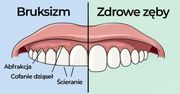 Bruksizm to poważny problem. Sprawdź jak przestać zgrzytać zębami