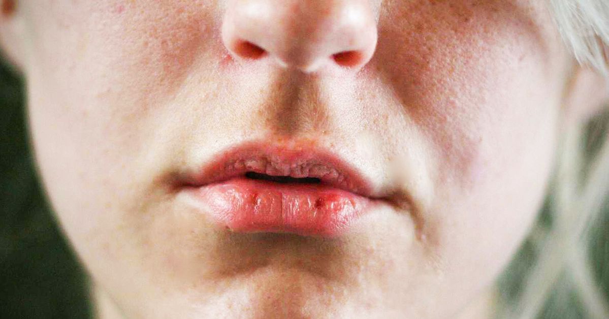 6 poważnych powodów, przez które Twoje usta są wysuszone. Odwodnienie to nie wszystko