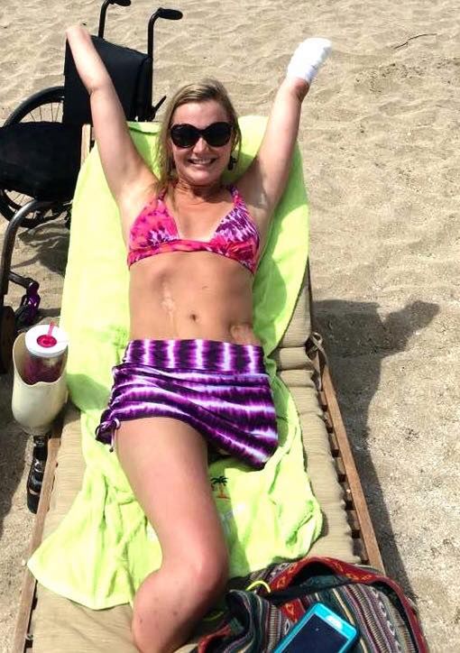 Jej zdjęcie w bikini poruszyło tysiące internautów. Historia Aimee Copeland